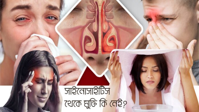 sinusitis